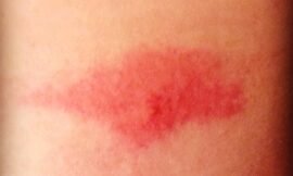 Utterly slaughtered by some sort of bug on the way back from Ohio. This bite under my bra strap is about the length of two quarters! #projectlife365