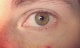 Three days post smacking g myself in the face with the car door. A tiny bit of orange, but that’s it. Yay! I do keep getting funny looks in checkout lines though. #projectlife365