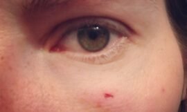 The morning after hitting myself in the face with the car door. Not as bruised or swollen as expected, and no black eye, so my record of never having one still remains! #projectlife365